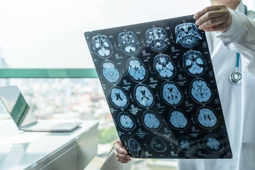 Brain Injuries Scans